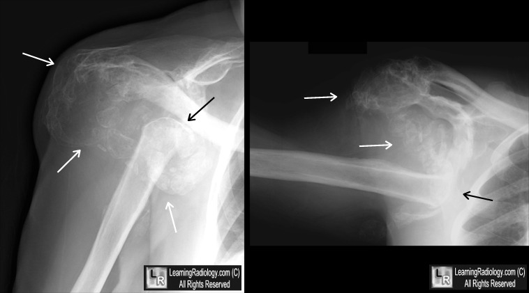 Charcot arthropathy shoulder